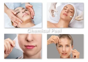 chemical peel 500x500 1