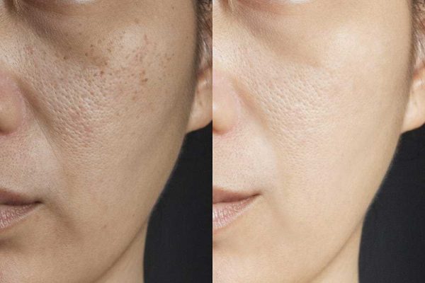 Chemical peel healing process day by day