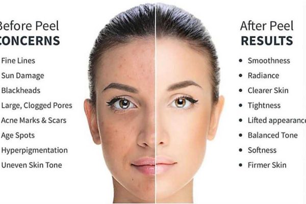 chemical peels 2 1024x611 1